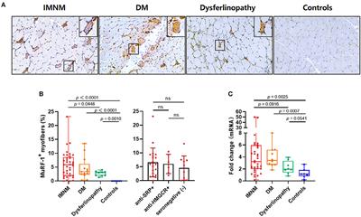 The accumulation of muscle RING finger-1 in regenerating myofibers: Implications for muscle repair in immune-mediated necrotizing myopathy